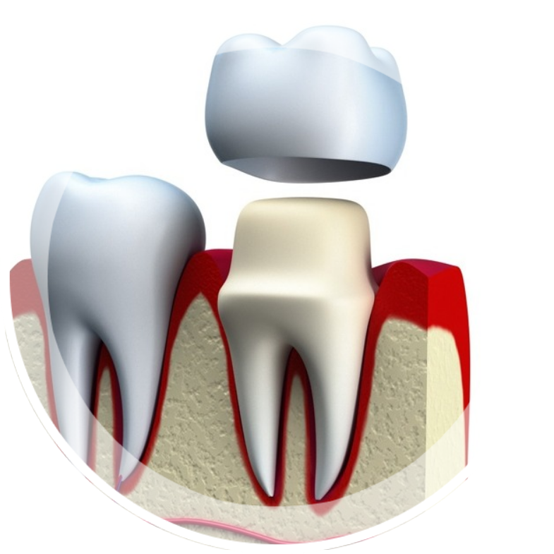 Коронка. Стоматологические коронки. Стоматологические коронки на зубы. Коронка зубная крепление.