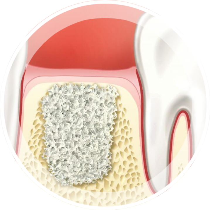 Имплантация тамбов. Костная ткань для имплантации. Наращивание кости при имплантации.